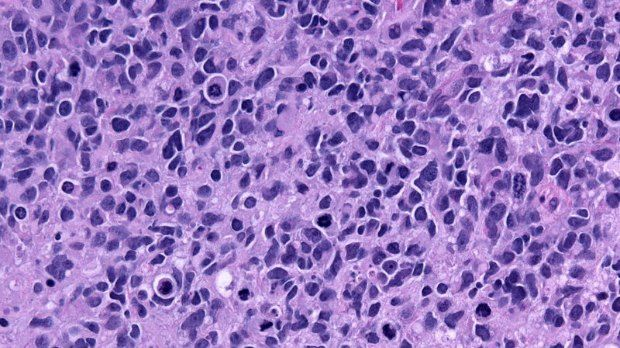 Science子刊：当心！广泛使用的人肿瘤细胞系U87MG被污染了